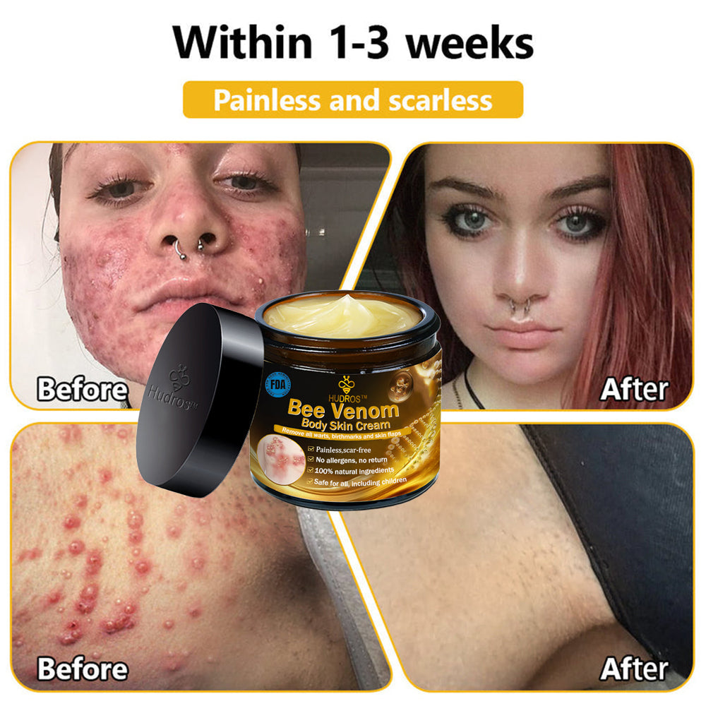 Hudros™ Bee Venom Body Skin Cream（AAD Recommended)🔥